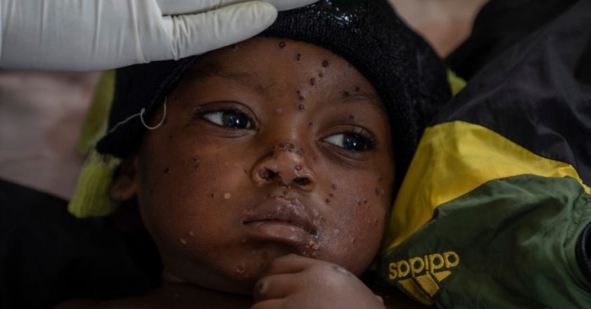 Mpox cases in Congo may be stabilizing, but more vaccines needed to stamp out virus 